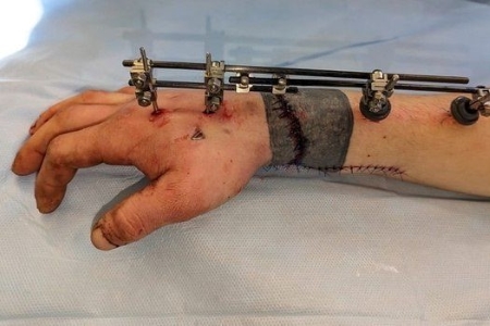 Кубанские врачи пришили молодому человеку отрубленную руку